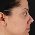Neck Liposuction Before & After Patient #2752