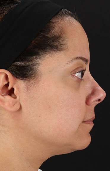 Neck Liposuction Before & After Patient #2752