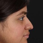 Neck Liposuction Before & After Patient #2763