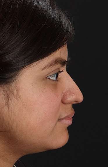 Neck Liposuction Before & After Patient #2763