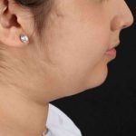 Neck Liposuction Before & After Patient #2774