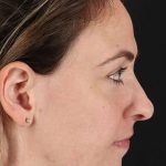 Neck Liposuction Before & After Patient #2785