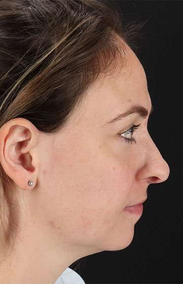 Neck Liposuction Before & After Patient #2785