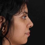 Rhinoplasty Before & After Patient #2818
