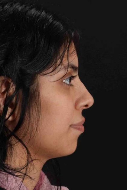 Rhinoplasty Before & After Patient #2818