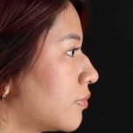 Rhinoplasty Before & After Patient #2829