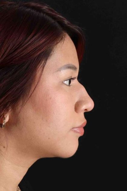 Rhinoplasty Before & After Patient #2829