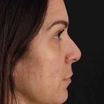Rhinoplasty Before & After Patient #2851