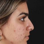 Rhinoplasty Before & After Patient #2862