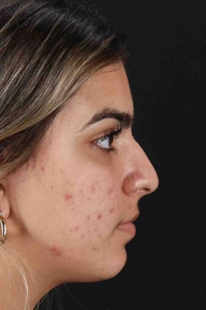 Rhinoplasty Before & After Patient #2862