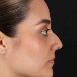 Rhinoplasty Before & After Patient #2873