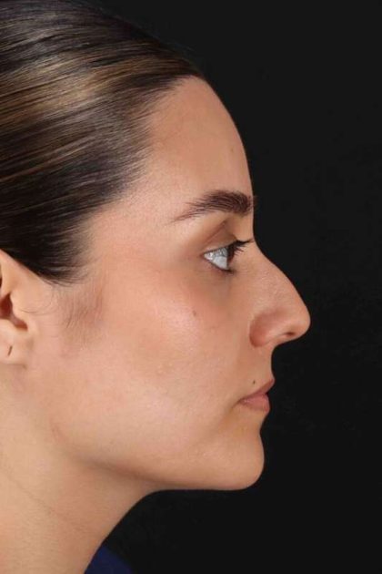 Rhinoplasty Before & After Patient #2873