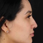 Rhinoplasty Before & After Patient #2895