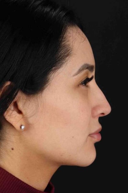 Rhinoplasty Before & After Patient #2895