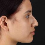 Rhinoplasty Before & After Patient #2917