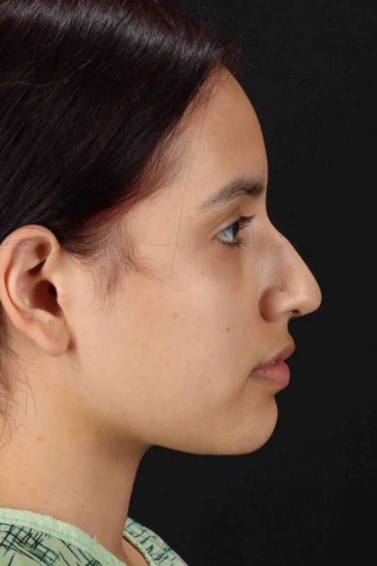 Rhinoplasty Before & After Patient #2917