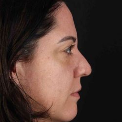 Browlift Before & After Patient #1363