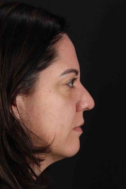 Browlift Before & After Patient #1363