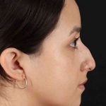 Rhinoplasty Before & After Patient #2928