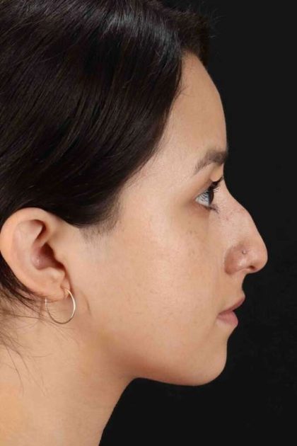 Rhinoplasty Before & After Patient #2928