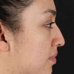 Rhinoplasty Before & After Patient #2939