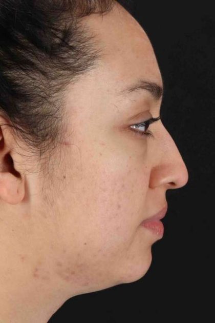 Rhinoplasty Before & After Patient #2939