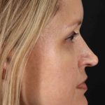 Rhinoplasty Before & After Patient #2950