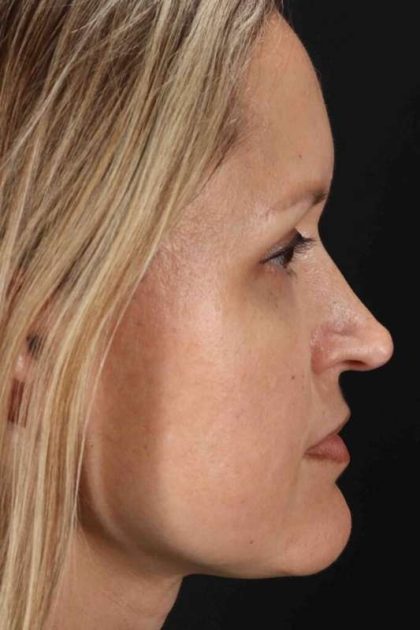 Rhinoplasty Before & After Patient #2950
