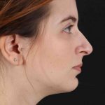 Rhinoplasty Before & After Patient #2961