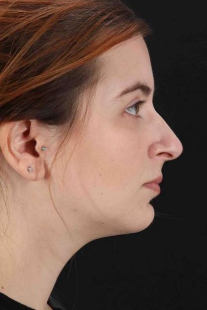Rhinoplasty Before & After Patient #2961