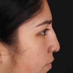 Rhinoplasty Before & After Patient #2972