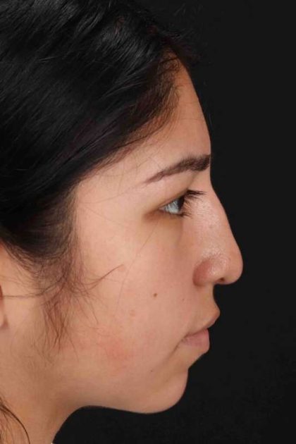 Rhinoplasty Before & After Patient #2972