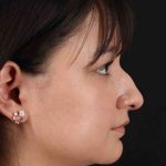 Rhinoplasty Before & After Patient #2983