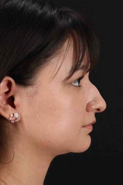 Rhinoplasty Before & After Patient #2983