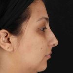 Rhinoplasty Before & After Patient #2994