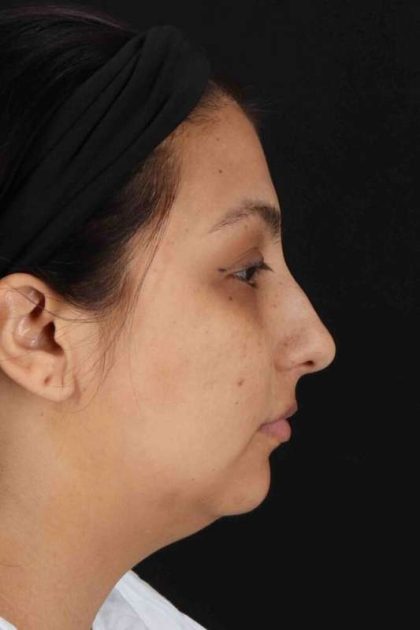 Rhinoplasty Before & After Patient #2994