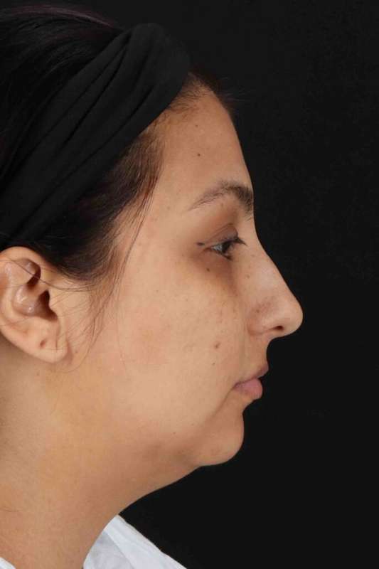 Rhinoplasty Before & After Patient #2994