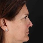 Rhinoplasty Before & After Patient #3005