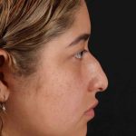 Rhinoplasty Before & After Patient #3016