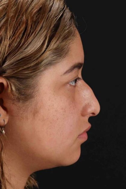 Rhinoplasty Before & After Patient #3016