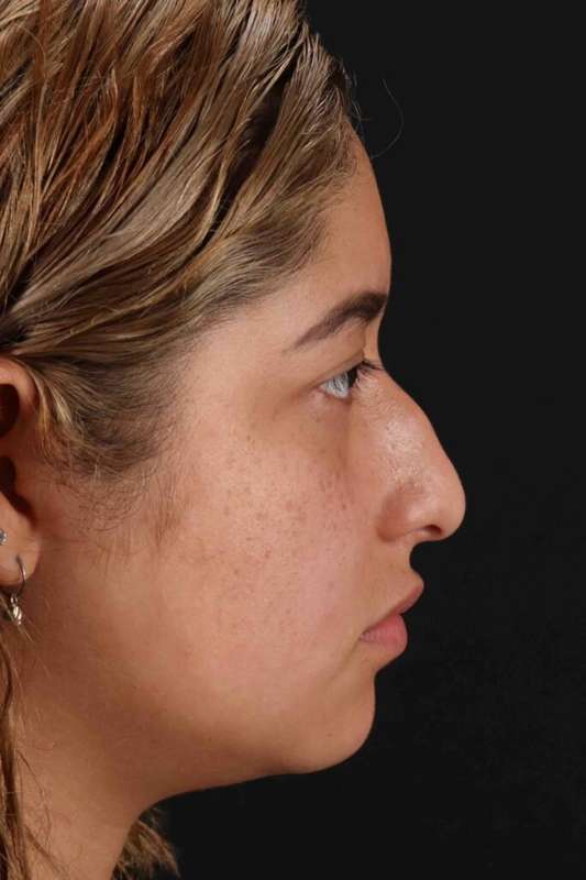 Rhinoplasty Before & After Patient #3016