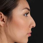 Rhinoplasty Before & After Patient #3027
