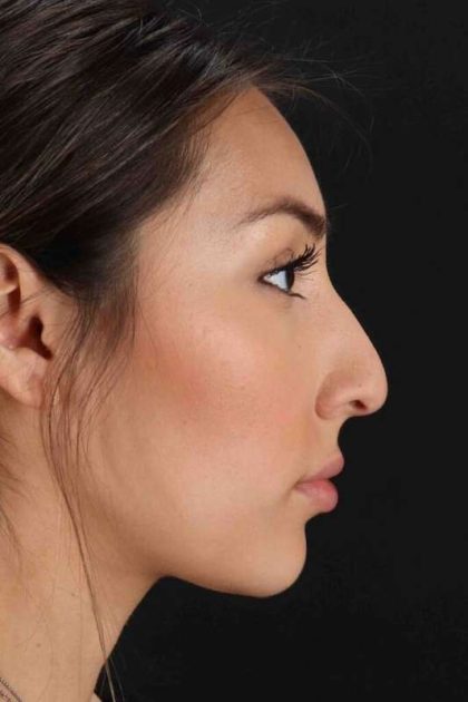 Rhinoplasty Before & After Patient #3027