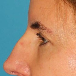 Browlift Before & After Patient #1373