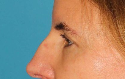 Browlift Before & After Patient #1373