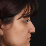 Rhinoplasty Before & After Patient #3038