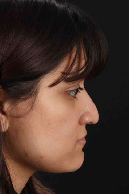 Rhinoplasty Before & After Patient #3038