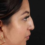 Rhinoplasty Before & After Patient #3049
