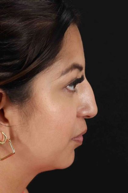 Rhinoplasty Before & After Patient #3049