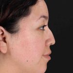 Rhinoplasty Before & After Patient #3060
